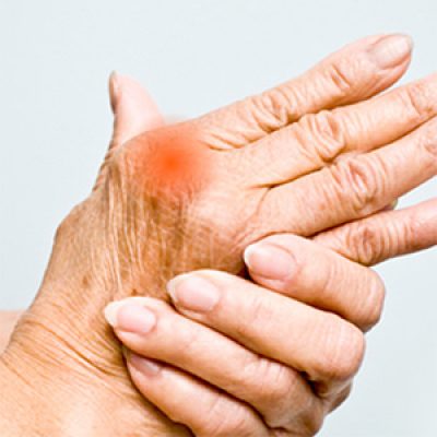 Arthritis Sufferers: Free CBD Access